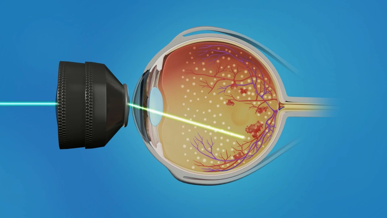 Retina CRVO Injections Laser