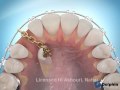 impacted canine tooth