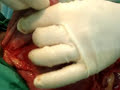 cirugia abdominal por perforacion intestinal cirugia abdominal por perforacion intestinal