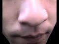 maggots from nose