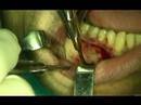 implant dental video preview 12