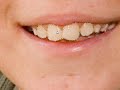 Fixing Teeth Fixing Teeth