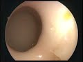 SKULL BASE AND SINUS ENDOTRAINER