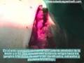 Melanoma extensivo superficial Clark ll