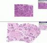 Histopathology Breast --Hyperplasia of lactation