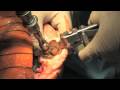 Total Knee Replacement Part 2: The Surgical Procedure