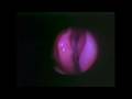 Anatomical Demonstration of FESS Part 1 of 5