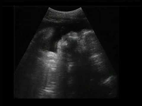 Ver video