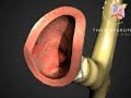 Así se realizó el primer transplante de tráquea sin fármacos