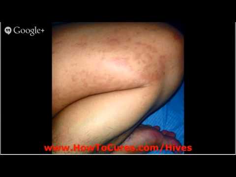 how to cure idiopathic urticaria