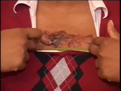 how to treat keloids