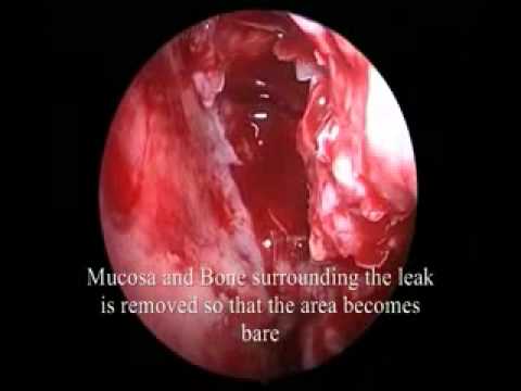 how to identify csf leak