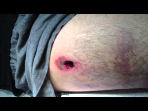 how to patch bullet hole in car