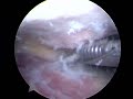 Shoulder Surgery Spur Removal