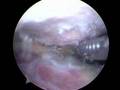 Shoulder Surgery Spur Removal