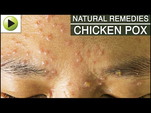 how to treat chicken pox