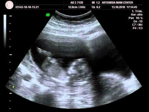 how to decide to do an amniocentesis