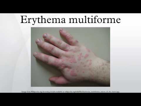 how to treat erythema multiforme