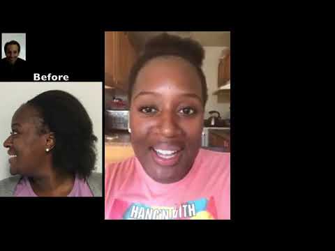 Traction Alopecia Hair Transplant Hair Transplant Before And After