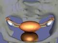 Tubal Ligation / Esterilizacion Femenina
