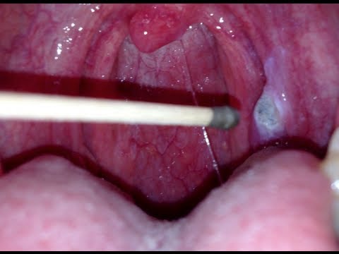 how to dissolve food stuck in throat
