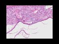 Histopathology Ovary--Dermoid cyst