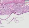 Histopathology Ovary--Dermoid cyst