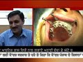 TV Interview of Implant Surgery Tooth fillings India, Part A