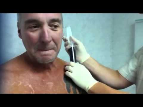 how to drain hematoma