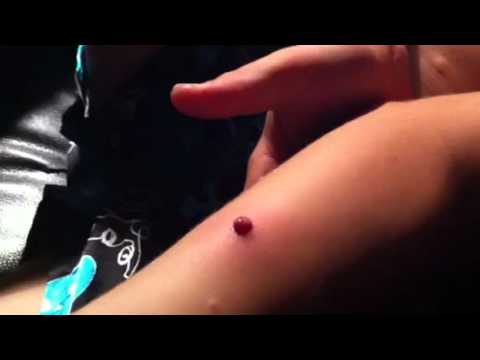 how to relieve pressure in a zit