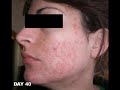 The Power of Accutane Isotretinoin