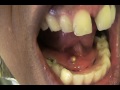 ** WARNING GRAPHIC AND NASTY** Clogged Salivary Gland Stone Self removal and DRAINAGE