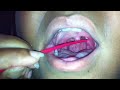Tonsil stone