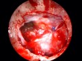 Pituitary Adenoma, Dural Suture Technique Pituitary Adenoma, Dural Suture Technique