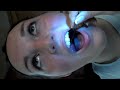 Hannahs tonsil