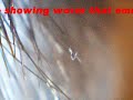 (01) VIEW - Worm emerged from Scalp and moving vigourously (01) VIEW - Worm emerged from Scalp and moving vigourously