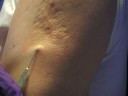 BCG Vaccination
