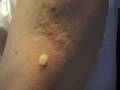 BCG Vaccination