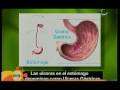 Ulcera Gástrica y del Duodeno parte 1 Ulcera Gástrica y del Duodeno parte 1