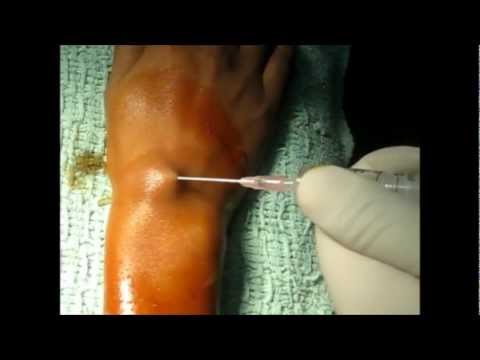 how to drain ganglion cyst