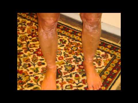 how to cure psoriasis on skin