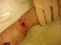 Radius fractur, removing pins