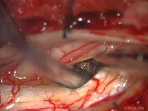 Spinal Cord Intramedullary Cavernous Malformations- Surgical Approaches - Video 2