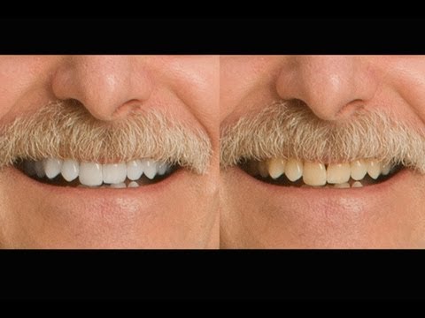 how to whiten gaps between teeth