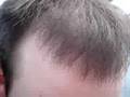 Hair Transplant by IAHRS Member Dr. Alan Feller