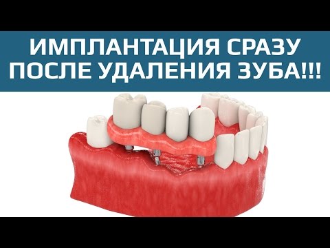Одноэтапная имплантация зубов