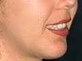 Gummy smile correction sonrisa gingival