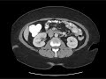 My CT Scan