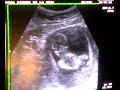 mi bebe 14w 3d