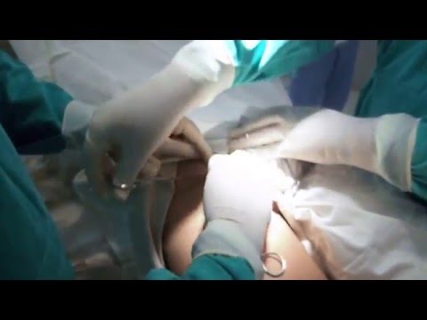 safenectomia - safenectomia no hospital são sebastião de recreio.